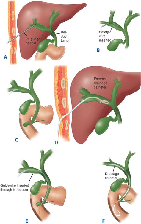 Venous Drainage Of Gallbladder