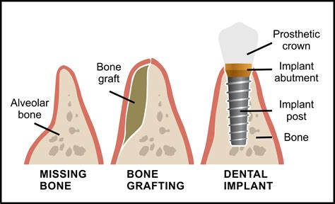 Bone Grafting for Dental Implants - Sherway Gardens Dental Centre