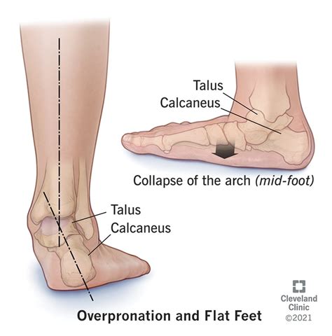 Overpronation: What It Is, Causes & Treatment