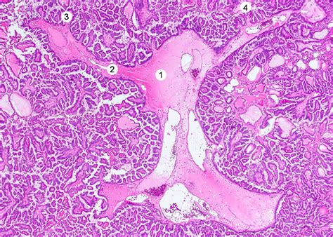 Pathology Outlines - Papillary thyroid carcinoma overview