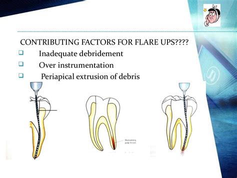 Flare up in endodontics