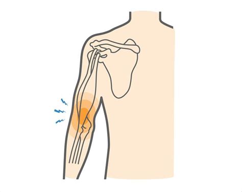 Distal Biceps Tendonitis | Upswing Health | Bicep tendonitis ...