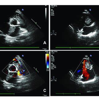 Figure1.Clinical symptoms indicating Carney complex. (A) Cardiac myxoma... | Download Scientific ...