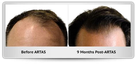 Before and After Images – Hair Transplant Austin Texas