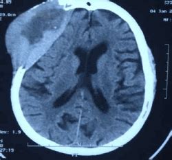 Cranial plasmacytoma as the presentation of relapsed multiple myeloma: a case report