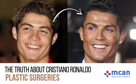 Cristiano Ronaldo Teeth