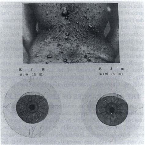 Differential diagnosis of Lisch nodules. Left: The original ...