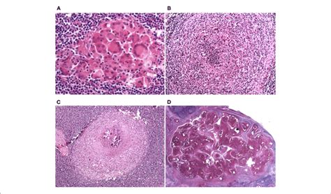 | Lymph node, granuloma maturational stages. (A) Stage 1 (initial ...