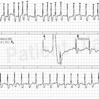 Successful electrical cardioversion of atrial fibrillation using... | Download Scientific Diagram