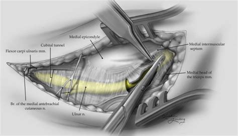 Ulnar Nerve Decompression at the Elbow - Kaitlin Lindsay