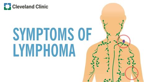 Warning Signs of Lymphoma - YouTube