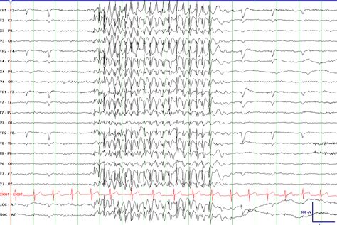 Juvenile Absence Epilepsy | Epilepsy Foundation