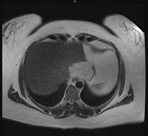 MR ABDOMEN WITH AND WITHOUT IV CONTRAST - Greater Waterbury Imaging Center