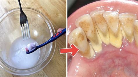 DIY Mouthwash: Remove All Plaque from Teeth in 2 Minutes | Remove ...