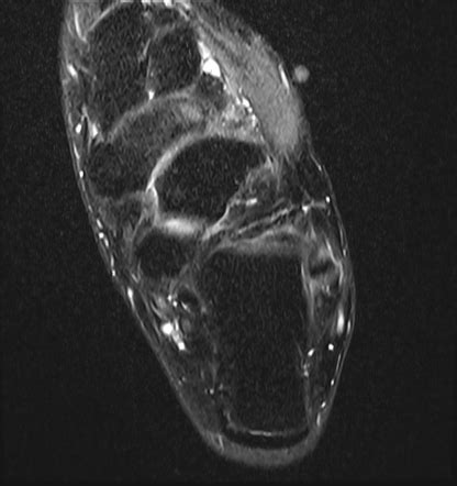 Müller-Weiss syndrome | Radiology Case | Radiopaedia.org