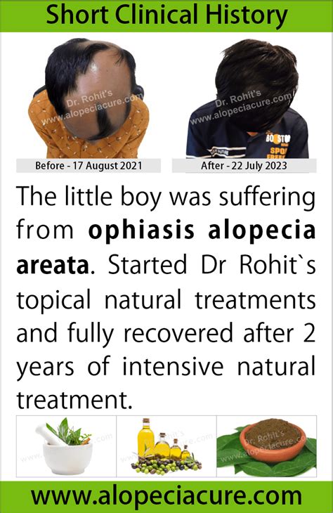 ophiasis alopecia areata treatment