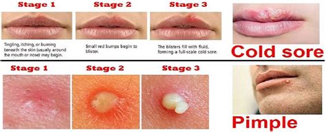 Cold Sore or Pimple | Cold sore or pimple, Cold sore, Pimples