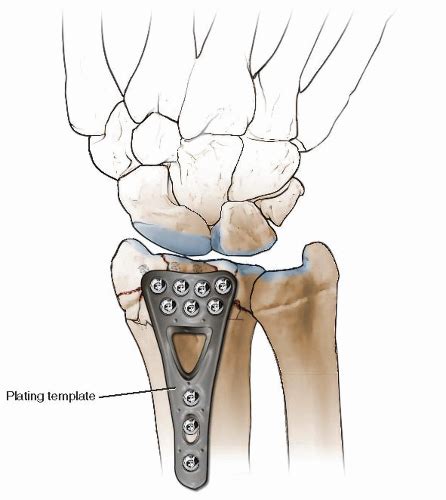 Distal Radius Fracture Reduction