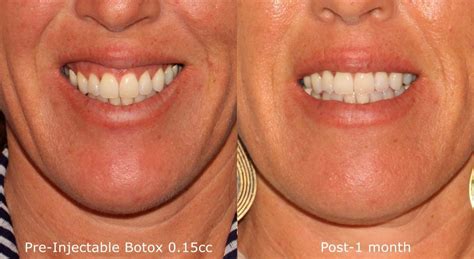 San Diego Botox Injections Medical Spa | San Diego, CA | CLDerm