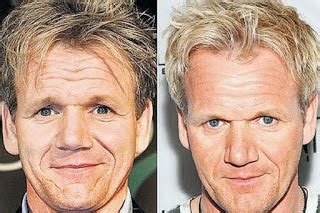 Gordon Ramsay Plastic Surgery Facelift Before and After (Star plastic ...