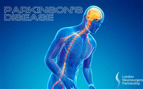 Parkinson's Disease - London Neurosurgery Partnership