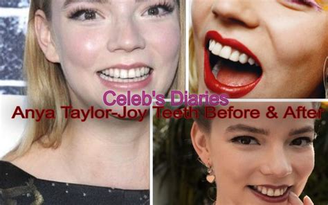 Anya Taylor-Joy Before Plastic Surgery - Botox, Nose Job, Lips, and ...