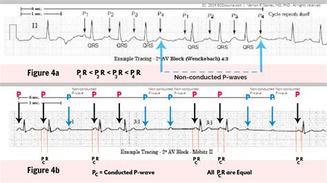 Mobitz I vs II Figure 4 Blog 2019 - ECGcourse.com