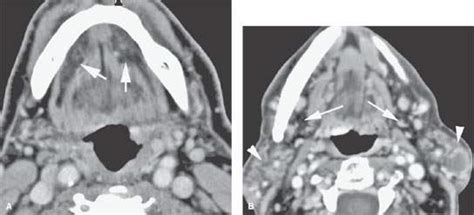 Tumors of the Sublingual Gland and Space and Tumorlike and Inflammatory Conditions | Radiology Key