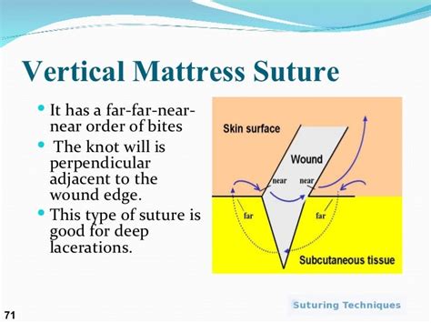 Mattress: Vertical Mattress Suture