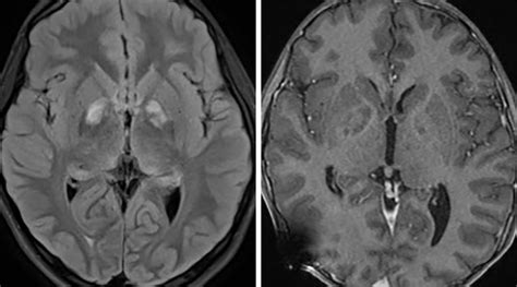 Neurofibromatosis Type 1 Mri