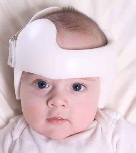 Plagiocephaly causes, symptoms, diagnosis & treatment