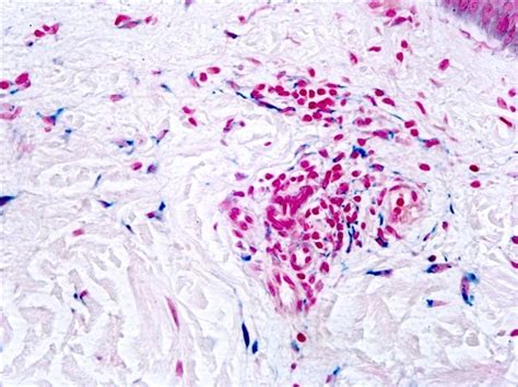 Pigmented Purpuric Eruptions (all variants: Schamberg’s disease [capillaritis], Purpura ...