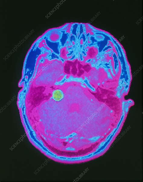 False-colour axial MRI scan: acoustic neuroma - Stock Image - M220/0079 ...