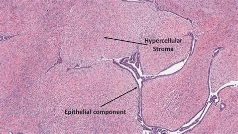 PHYLLODES TUMOR - Pathology Made Simple