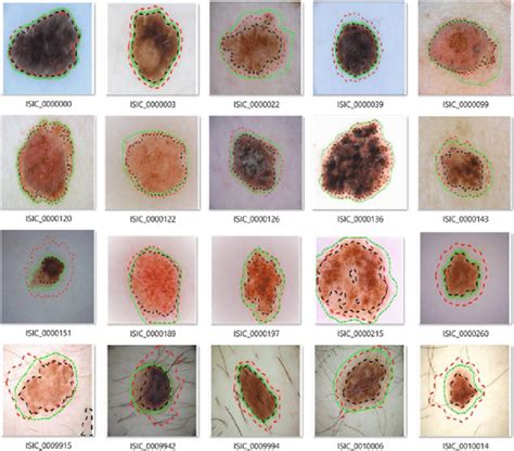 Boundaries presentation of the segmented skin lesions by the methods ...