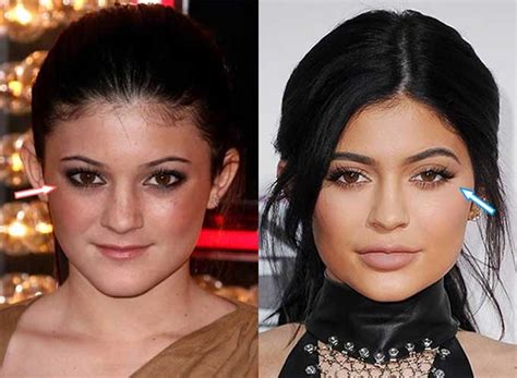 Kylie Jenner Before and after: Nose Job, Lip Injections, Breast