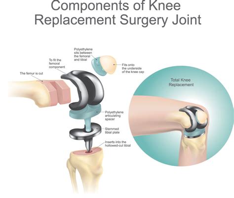 Knee Replacement Surgery (Total Knee Arthroplasty) - Schulze Orthopedics