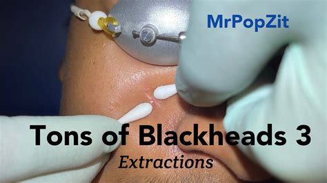 Tons of Blackheads part 3. Acne extractions. Many comedones removed. Patient improving. MrPopZit ...