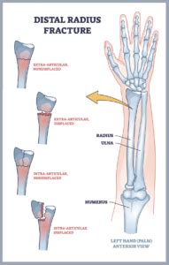 Sprained Wrist Vs Broken Wrist