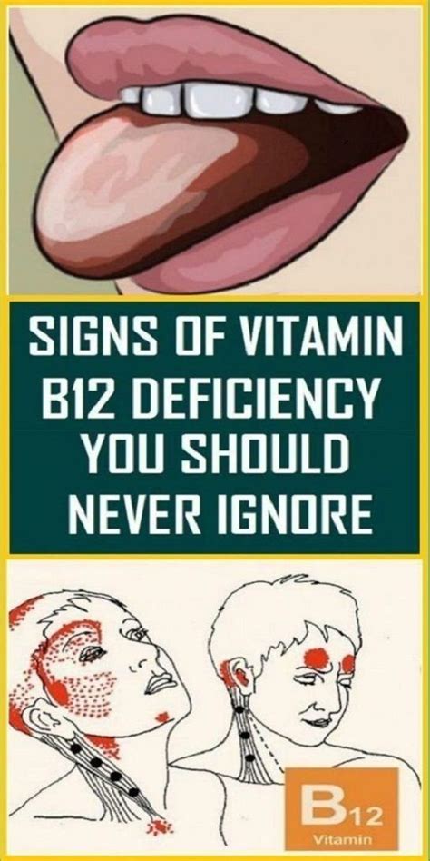 Signs of Vitamin B12 deficiency you should never ignore | Wellness 2 Know