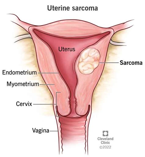 Stages Of Uterine Cancer