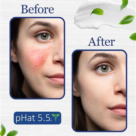 LHCER Skin Care Products, Nose Cleaning Cream,Rosacea, 57% OFF