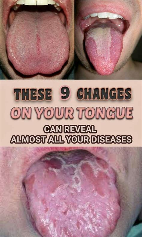 Be Aware Of THIS: These 9 Changes On Your Tongue Reveal Almost All Your Diseases | Healthy Day 100