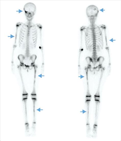 A case of McCune–Albright syndrome hiding in the bones - Journal of Pediatric Endocrinology and ...