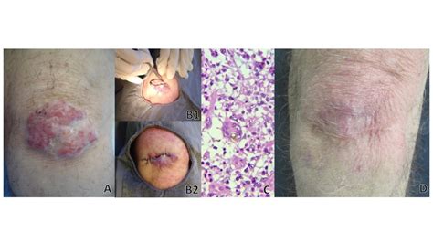 Chromomycosis located in the knee. Tumoral clinical appearance (A).... | Download Scientific Diagram