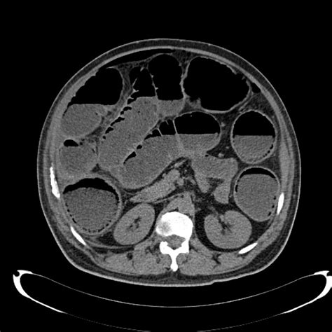 Gastrointestinal perforation CT - wikidoc