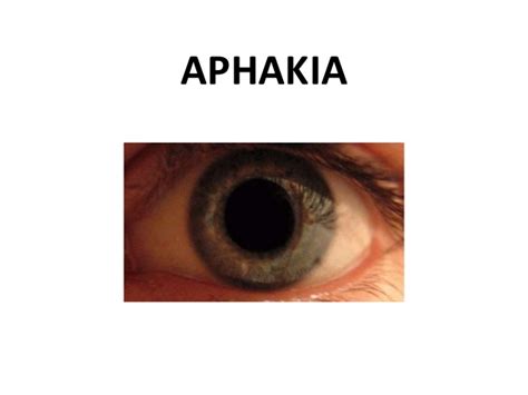 About Aphakia: Symptoms, Causes and Treatments Available