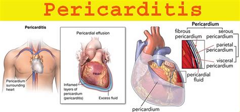 Pericarditis - Causes, Symptoms, Prognosis, Diagnosis, Treatment