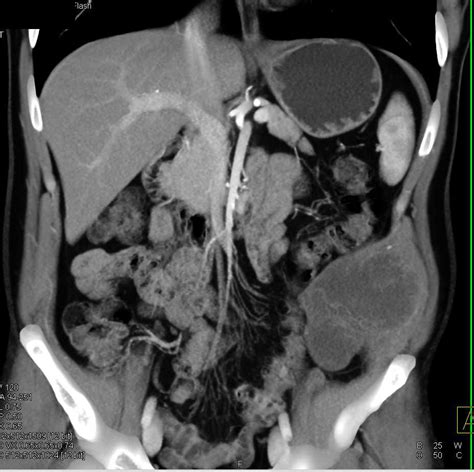 Liposarcoma Involves Abdominal Wall - Musculoskeletal Case Studies - CTisus CT Scanning