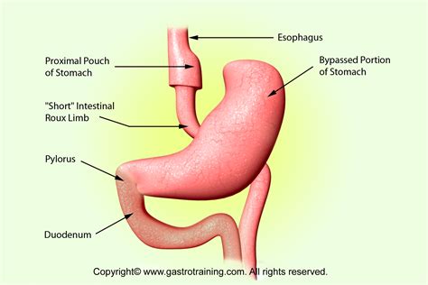 Gastroenterology Education and CPD for trainees and specialists » Roux-en-Y gastric bypass